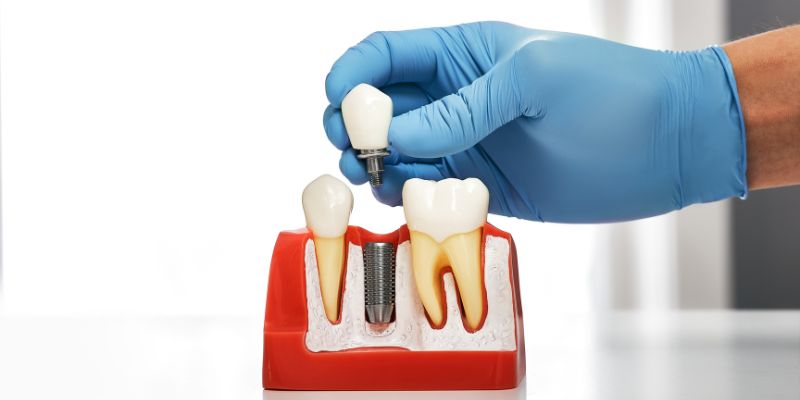 What Are Dental Implants?