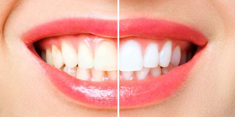 What is Teeth Whitening?