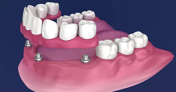 Dentures