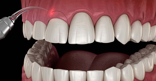 Gingivectomy