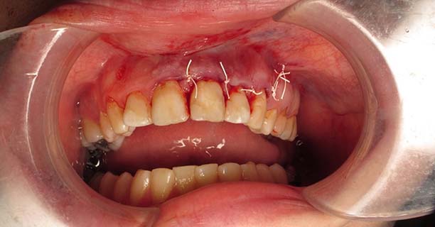 Apicoectomy